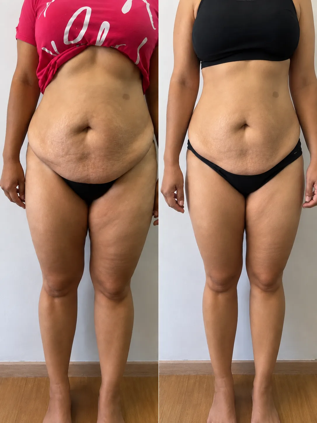 Antes e depois de Criolipólise: abdômen e coxas, vista frontal