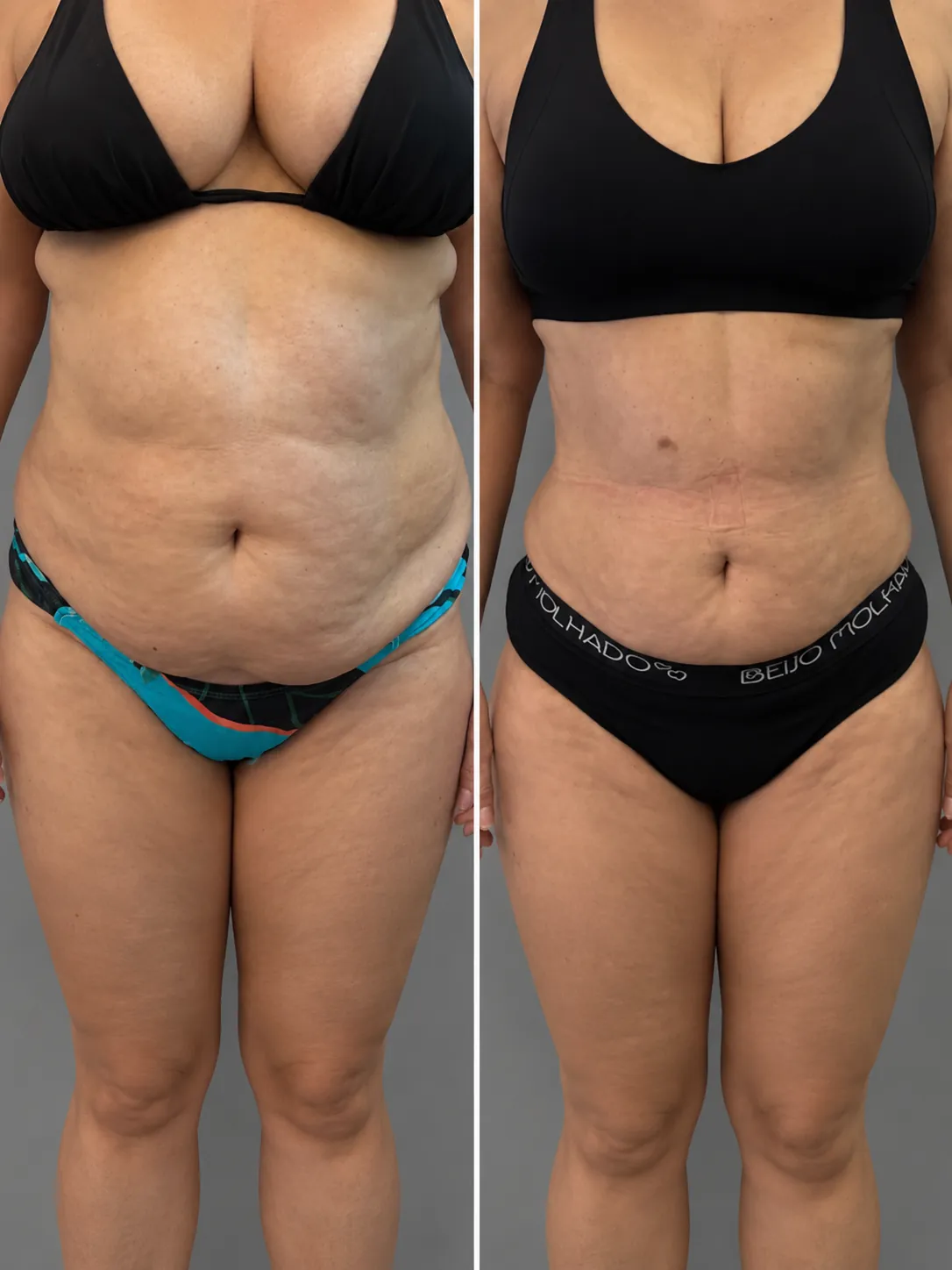 Antes e depois de Enzimas: abdômen, vista frontal