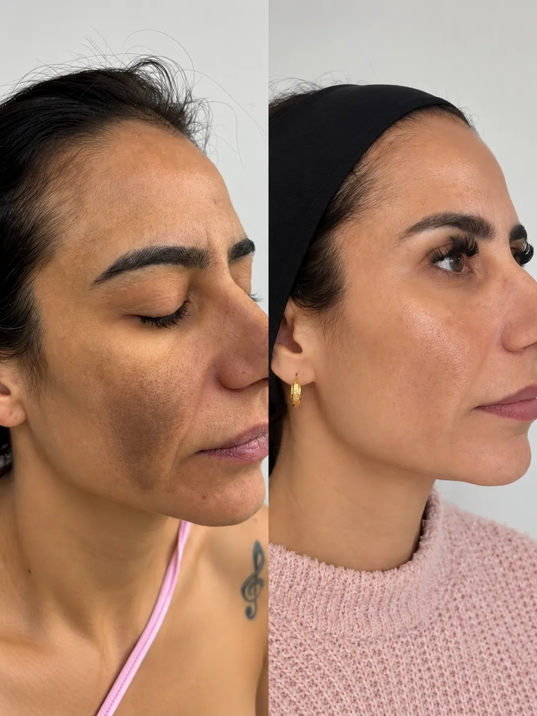 Antes e depois de Lavieen: rosto, vista frontal