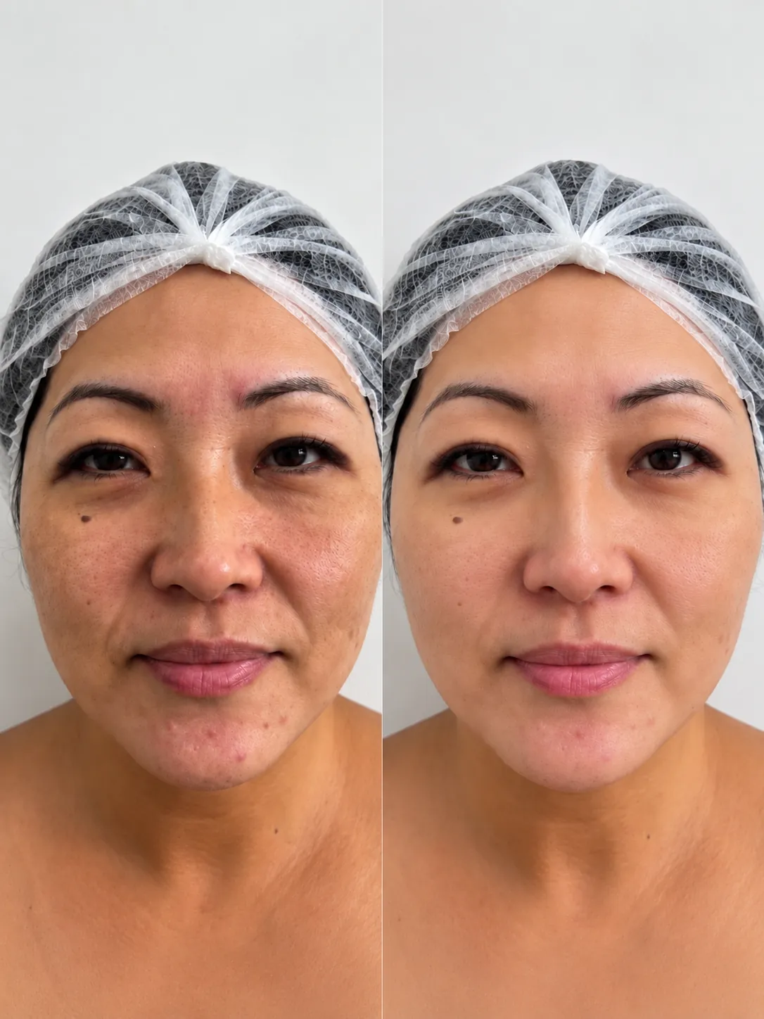 Antes e depois de Lavieen: rosto, vista lateral