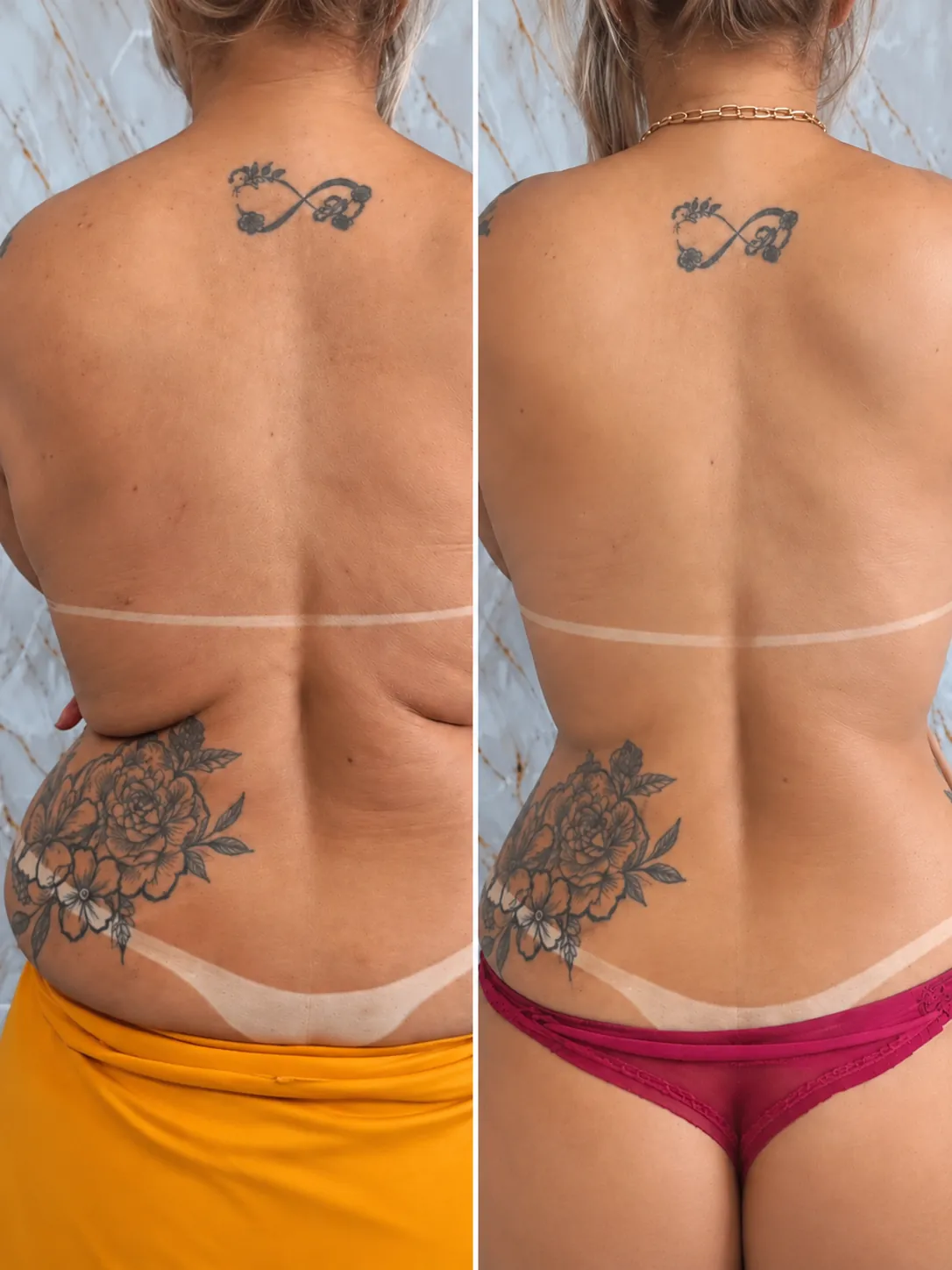 Antes e depois de Thermolaser: costas e flancos, vista posterior